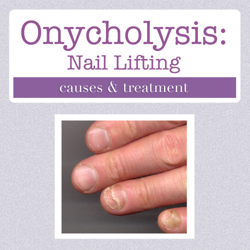 Nail Lifting, or Onycholysis: Why Does It Happen?