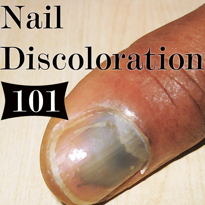 What Discoloration of the Nail Means