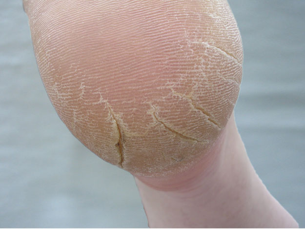 NP Four Foot Problems Cracked Heels - Learn How To Identify And Address Four Major Foot Problems