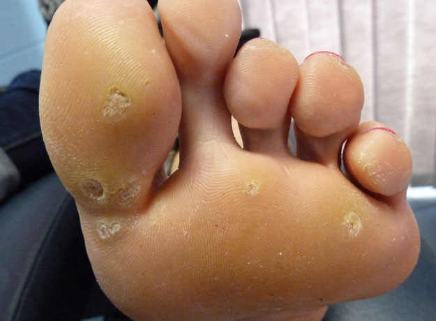 NP Four Foot Problems Plantar Wart - Learn How To Identify And Address Four Major Foot Problems